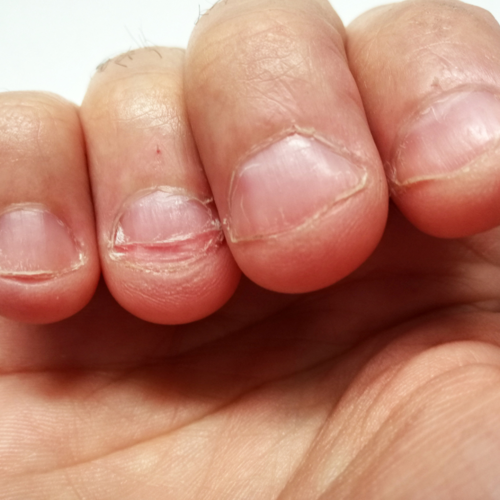 Both my index fingers look like that, i'm 1 week clean of biting my nails,  stopping isnt the problem now, but wondering will my index fingers ever  grow back properly? : r/nailbiting